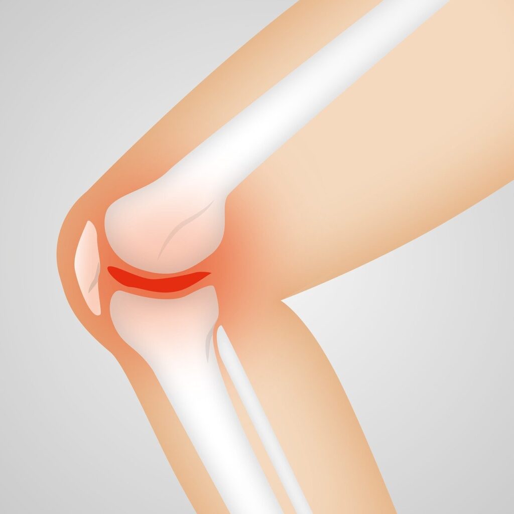 arthrocalman, osteoarthritis, knee replacement surgeon in indore