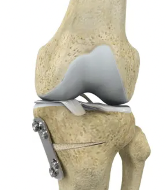 high tibial osteotomy surgery in Indore