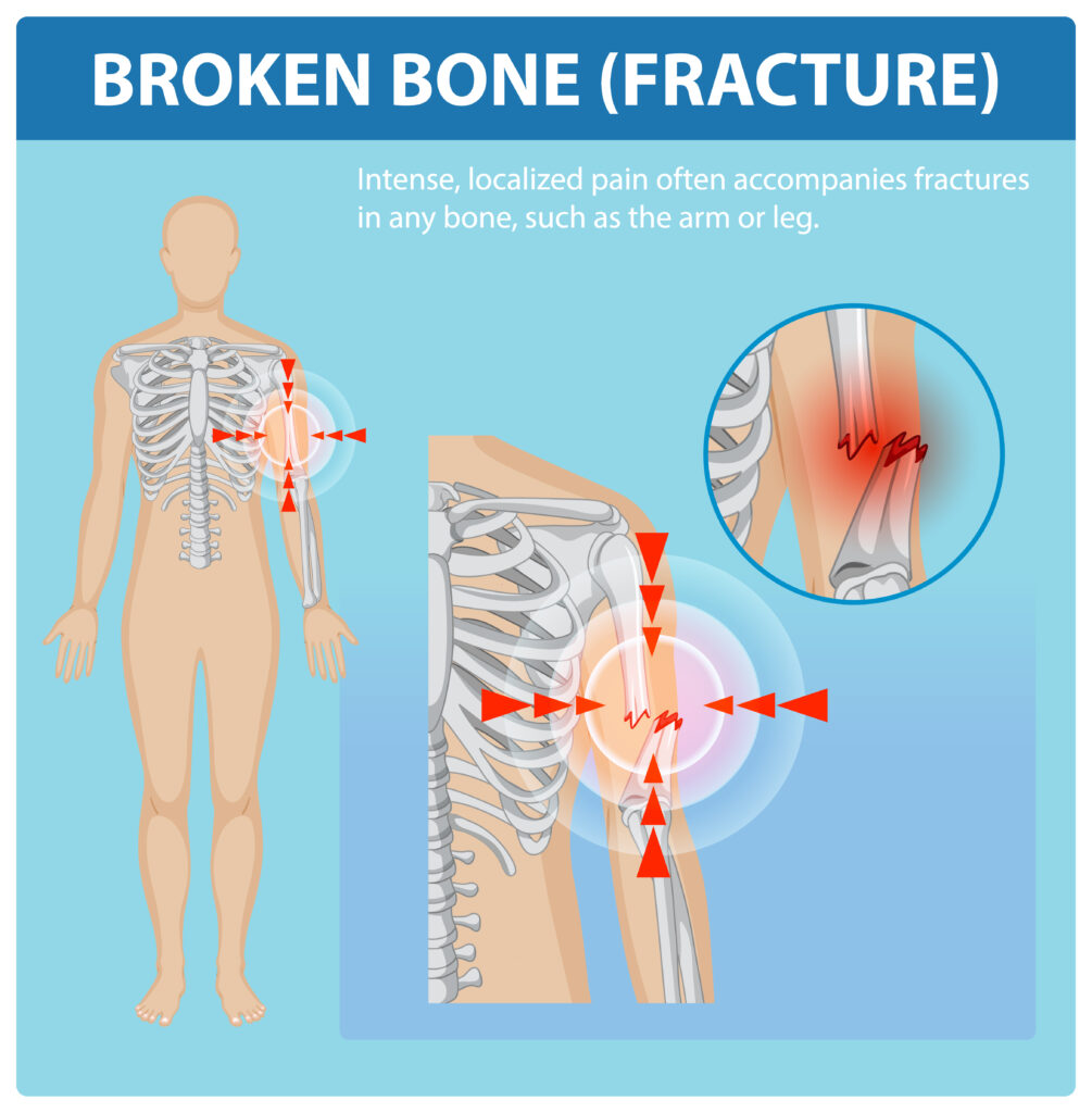 Types of fracture